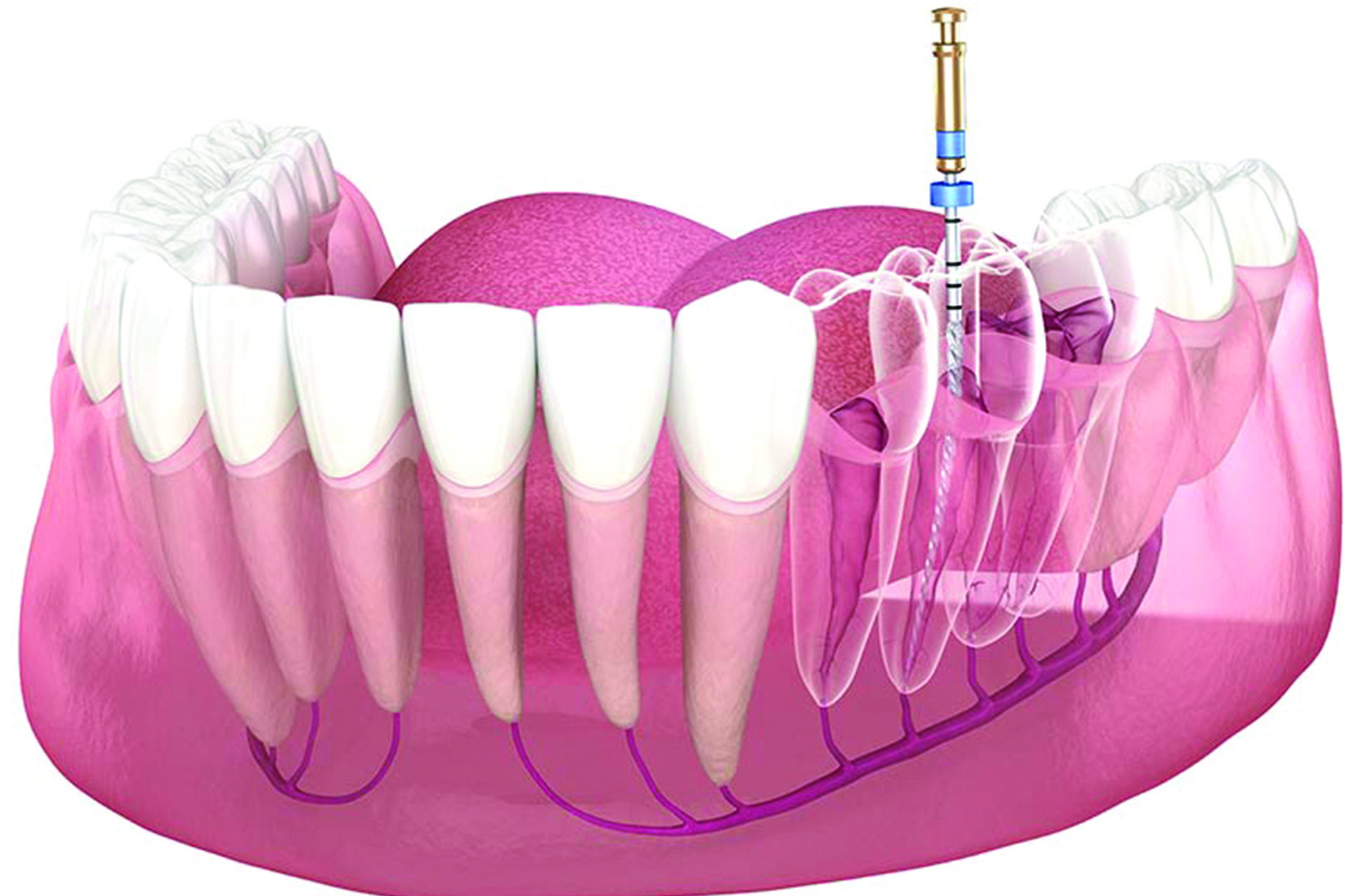 Root Canals
