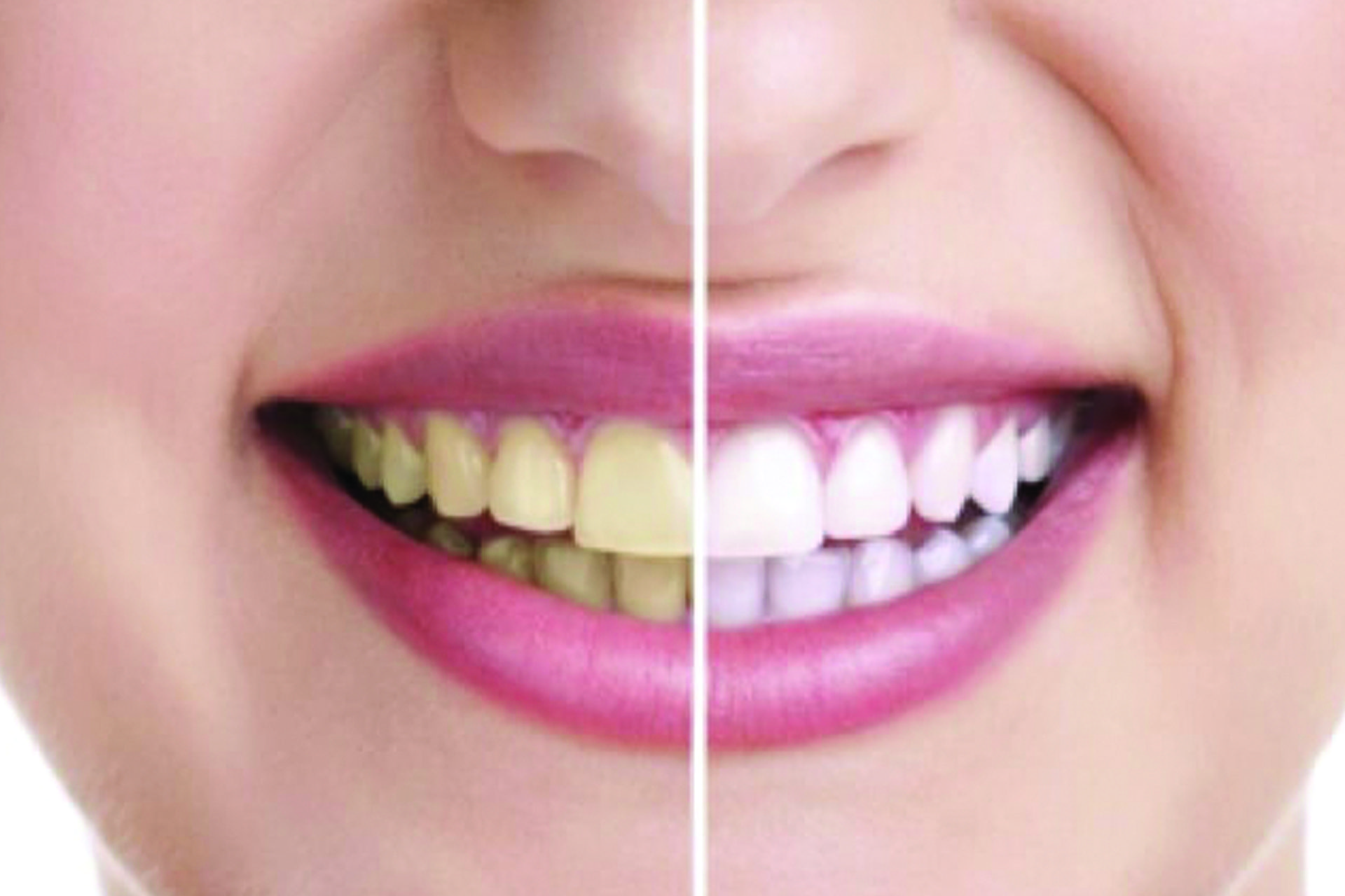 ZOOM-TEETH-WHITENING