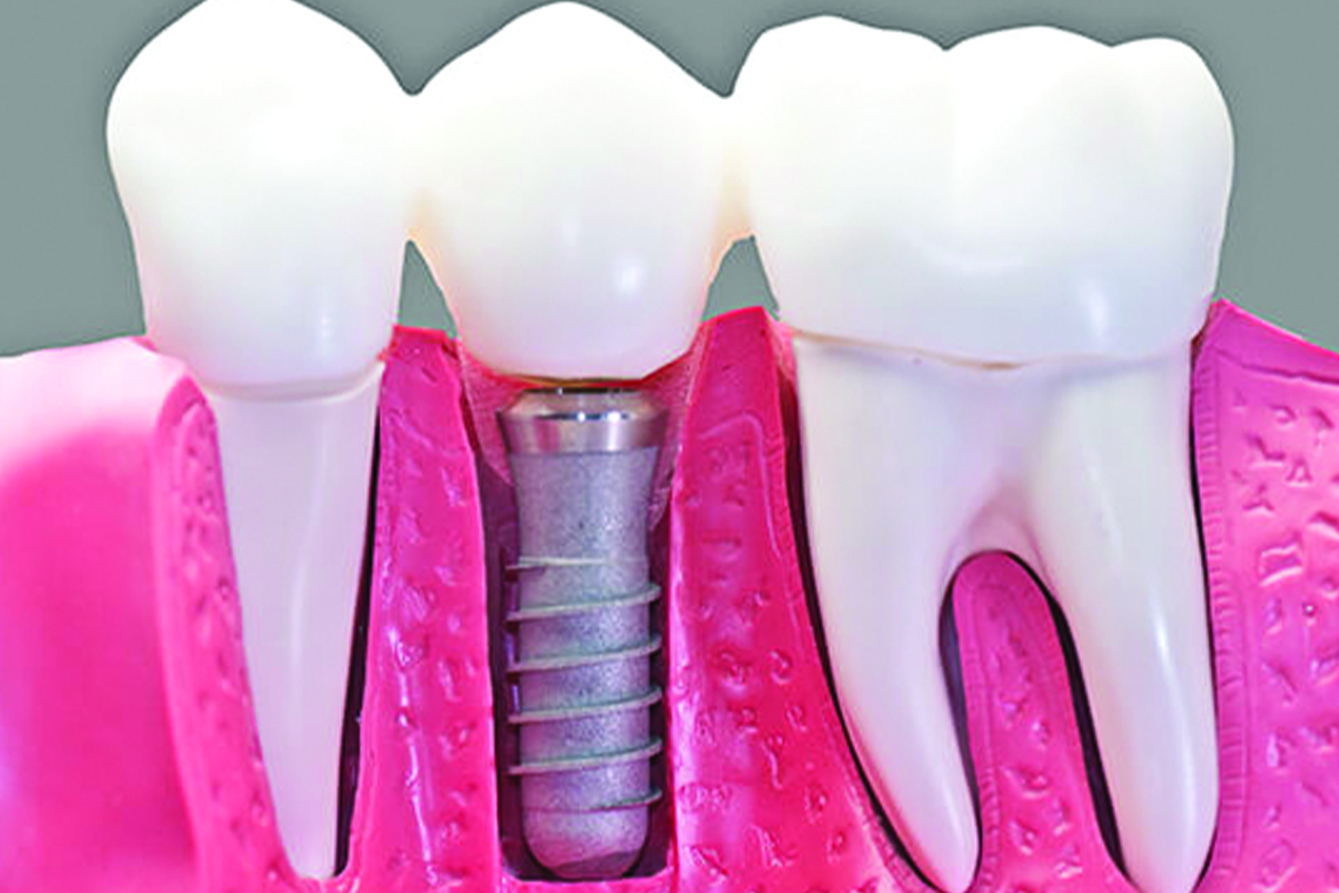 Implants